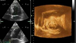 4D ECHO TENDON ANTERO SEPTAL AKINESIA [upl. by Sair]