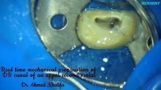 Real time mechanical preparation of a DB canal of an upper second molar [upl. by Atiker763]