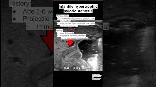 Infantile hypertrophic pyloric stenosis [upl. by Llenrahc]