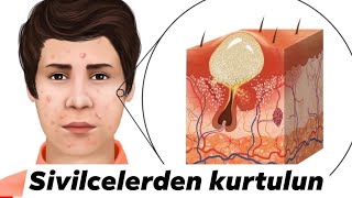 SİVİLCELERDEN KALICI OLARAK NASIL KURTULURUZ Sivilce [upl. by Olli]