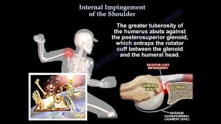 Internal Impingement of the shoulder Everything You Need To Know  Dr Nabil Ebraheim [upl. by Drooff]