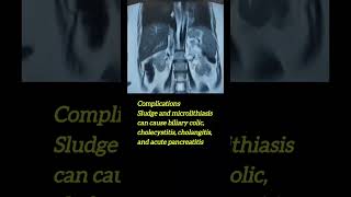 gallbladder sludge with microlithiasis [upl. by Hilar]