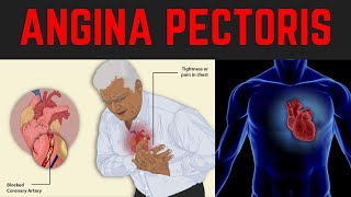 ANGINA PECTORIS  Chest Pain  Types  Causes Risk factors  NITROGLYCERIN  Management [upl. by Itch540]