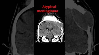 Meningioma shorts radiology education radiologyjunction [upl. by Clayson]