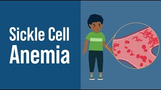 Sickle Cell Anemia [upl. by Anais]