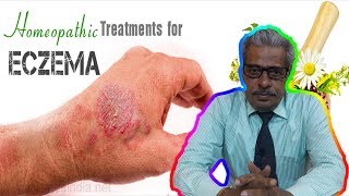 Eczema Dermatitis Treatment in Homeopathy by Dr PS Tiwari [upl. by Rutherford]