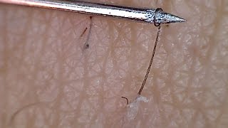 Long Ingrown Hair [upl. by Elatnahs]