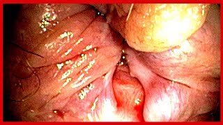 Blutende Hämorrhoiden ✔ 3 effektive Möglichkeiten um blutende Hämorrhoiden zu beseitigen [upl. by Westmoreland311]