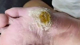 A big callus on the foot Clean up slowly【Joo Yidao】 [upl. by Vod]