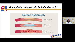 MIOT Hospital amp The Hindu Present Genicular Artery Embolization [upl. by Haisej]