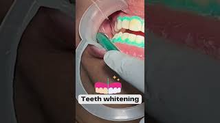 Step By Step Teeth Whitening Process  Happy Smiles Dental Care  DCH [upl. by Haisej]