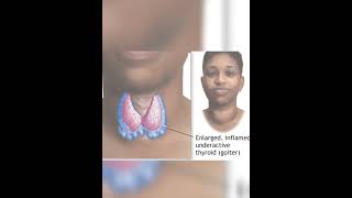 Learn Thyroid gland hypothyroidismclass 11 part2 trendingshortsneet science factseducation [upl. by Shifra]