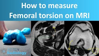 How to Measure Femoral Torsion on MRI [upl. by Welles]