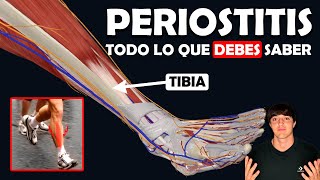 PERIOSTITIS TIBIAL Su TRATAMIENTO y lo que debes saber [upl. by Harper]