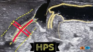 Hypertrophic pyloric stenosis [upl. by Imef859]