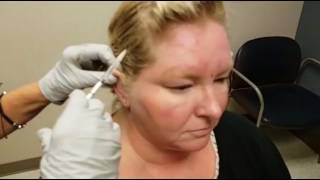 Botox for Migraines at Mercy [upl. by Koffler]