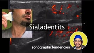 Sialadenitis [upl. by Biron]