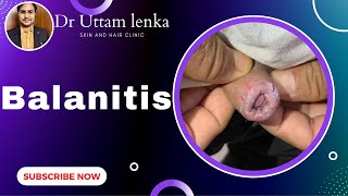 Balanitis  crack of fore skin of penis candidiasis medicines for penis infectionDr Uttam Lenka [upl. by Vickey]