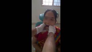 Jaw Joint Dislocation Slip  Manual Reduction Self  at Home Treatment DIY [upl. by Tannie274]