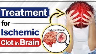 Treatment for Ischemic Clot in Brain  Ischemic Stroke in Paralysis  SRIAAS [upl. by Acinoev]