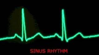 audible heart beat  extrasystoles  PVC and sinus beats [upl. by Atnim]