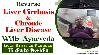 Can Ayurveda Reverse Liver Cirrhosis amp Chronic Liver Disease [upl. by Grevera400]