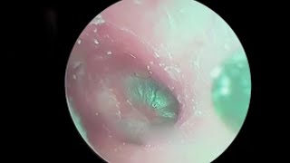 Ear wax removingsatisfying video for ear Fungus cleaning [upl. by Patrick]