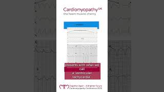 Diagnosing Arrhythmogenic Cardiomyopathy ACM [upl. by Belloir]