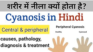 what is cyanosis  causes types amp treatment in Hindi [upl. by Yirinec]