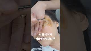 리팟 레이저 다발성 흑자 세종리팟 세종시리팟 reepot lentigo multiplelentigo 청주리팟 공주리팟 대전리팟 오창리팟 오송리팟 부여리팟 [upl. by Yhtomiht738]