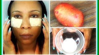 HOW TO USE POTATO TO GET RID OF DARK UNDER EYES CIRCLES  DOES IT WORK  Khichi Beauty [upl. by Kinzer]