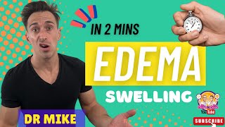 Edema Oedema  In 2 minutes [upl. by Seale]