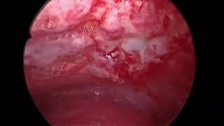 Rigid Thoracoscopy  Pleural Biopsy  Talc Poudrage  Malignant Pleural effusion [upl. by Melleta]