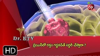 Dr ETV  Blood clot in brain  Treatment  18th March 2017  డాక్టర్ ఈటివీ [upl. by Esinad]