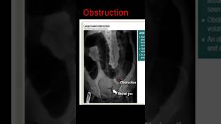 Bowel Obstruction shorts radiology [upl. by Nwahsuq]