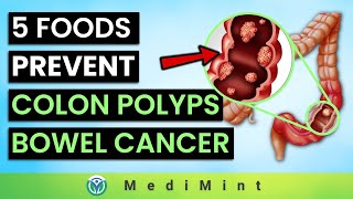 Top 5 Foods to Prevent Colon Polyps Bowel Cancer ADD Foods To Limit or Avoid  MediMint [upl. by Yuhas116]