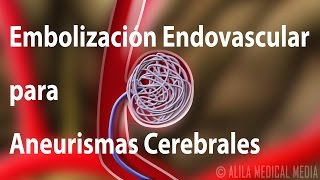 Embolización Endovascular para Aneurismas Cerebrales Alila Medical Media Español [upl. by Gram182]