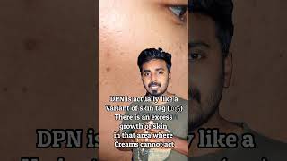 DPN removal from Face  Is it harmful Skin tag  மரு  Dr Thamizhinian  Dermatologist skintags [upl. by Oiratnom228]