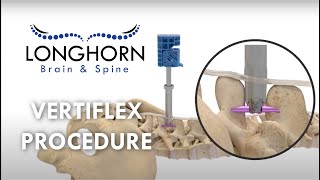 Longhorn Brain and Spine  Vertiflex Procedure [upl. by Nema]