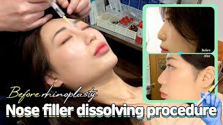 How to Dissolve Nose Filler Before hooked nose rhinoplasty or nose job [upl. by Gladi]