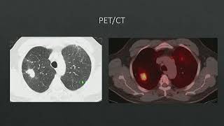 Pneumoconiosis [upl. by Binnie]