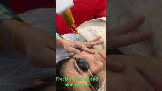 Freckle removal derma freckles skintoning [upl. by Minne]