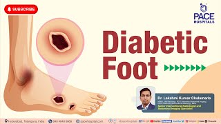 Diabetic Foot  Stages Causes Symptoms Diagnosis Prevention amp Treatment  Diabetic Foot Ulcers [upl. by Joung]