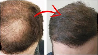 Hair Transplant for Diffuse Thinning Shocking results [upl. by Andrien259]