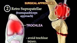 Intramedullary Nailing Proximal Tibial Fractures  Everything You Need To Know  Dr Nabil Ebraheim [upl. by Haletta]