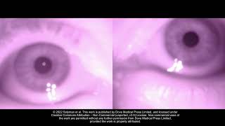 Smartphone Infrared Pupillography and Pupillometry  Supplementary video 2 ID 331989 [upl. by Anabella]