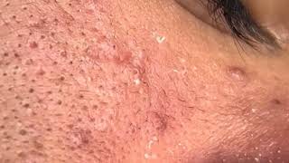 how to remove forehead pimples in one day  white blackheads on face  comedones treatment [upl. by Niuq381]