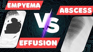 Empyema vs Lung Abscess vs Pleural Effusion on IMAGING [upl. by Floridia]