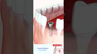 Dental Implant Front Tooth shorts [upl. by Worra64]