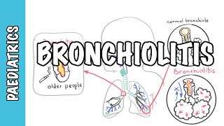 Bronchiolitis causes pathophysiology signs and symptoms treatment [upl. by Ilojne]